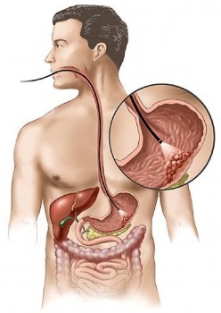 stomach_cancer