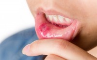 Άφθες στο στόμα: Πότε δείχνουν σοβαρό πρόβλημα υγείας