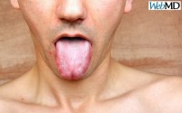 Μυκητίαση στο στόμα: Αίτια και συμπτώματα