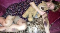 Ξύπνησε γεμάτη μώλωπες – Ήταν η αρχή του Γολγοθά της Ξύπνησε γεμάτη μώλωπες – Ήταν η αρχή του Γολγοθά της