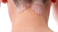 to-84-ton-asthenon-me-psoriasi-ifistante-diakrisis-exetias-tou-dermatos-tous Tο 84% των ασθενών, με ψωρίαση, υφίστανται διακρίσεις εξαιτίας του δέρματός τους