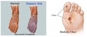 Διαβητικό πόδι