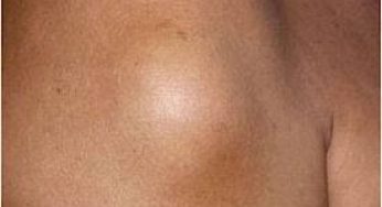 Καλοήθεις παθήσεις (κύστεις, ιδρωταδενίτιδα, ξανθελάσματα) και καλοήθεις όγκοι (σπίλοι, λιπώματα) του δέρματος.