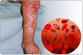 σηπτικό σύνδρομο