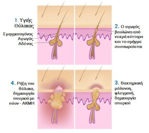 Φωτοδυναμική θεραπεία