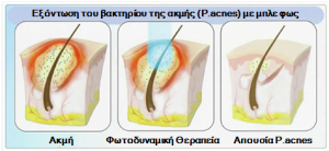 Φωτοδυναμική θεραπεία