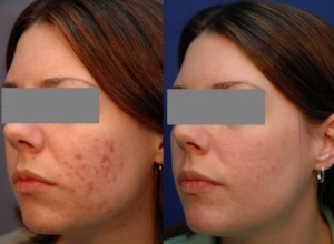 Φωτοδυναμική θεραπεία