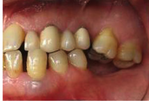 Απώλεια δοντιού