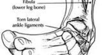 Διάστρεμμα Ποδοκνημικής Άρθρωσης και Φυσικοθεραπευτική Αντιμετώπιση