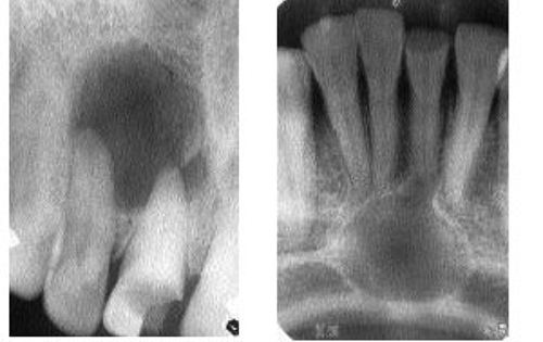 Τι είναι το κοκκίωμα και η κύστη; Ακρορριζικές Αλλοιώσεις που προκαλούνται από τερηδόνα, τραύμα, μικρόβια και τοξίνες.