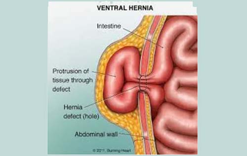 Αν κάποιος δεν αποκαταστήσει άμεσα την κήλη του, μπορεί στο μέλλον να αντιμετωπίσει σοβαρές συνέπειες στην υγεία του