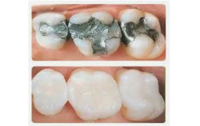 Χρήσιμες πληροφορίες για τα λευκά σφραγίσματα. Ποια τα πλεονεκτήματά τους;