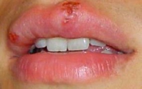 Επιχείλιος έρπης και ερπητοειδής στοματίτιδα. Αντιμετώπιση και ο κίνδυνος μόλυνσης του δάκτυλου και του ματιού.