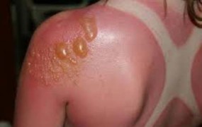 Τι είναι το ηλιακό έγκαυμα, ποια τα συμπτώματά του και πώς μπορούμε να το αντιμετωπίσουμε;