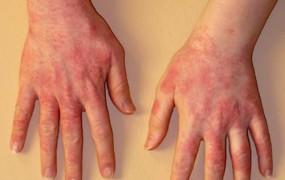 Βοηθήστε το δέρμα σας από το έκζεμα (δερματίτιδα).