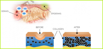 Μεσοθεραπεία2