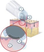Μεσοθεραπεία4