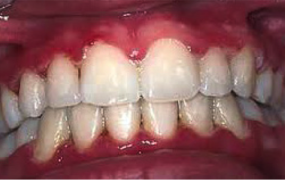 Έντονη κακοσμία, μεταλλική γεύση μπορεί να οφείλονται σε οξεία ελκονεκρωτική ουλίτιδα