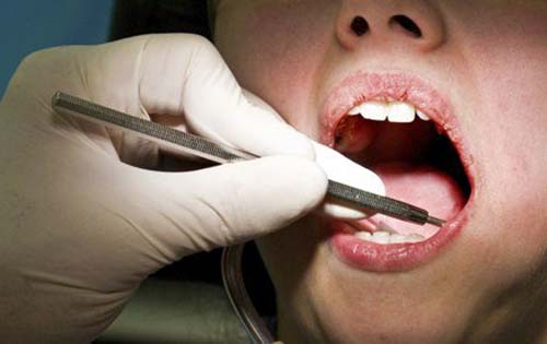 Πειραματική θεραπεία επιτρέπει την ανάπλαση κατεστραμμένων δοντιών