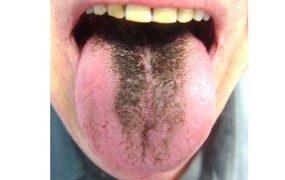 Είναι η γλώσσα σας άγρια, μαύρη ή καφέ και μοιάζει σαν να έχει βγάλει τρίχες; Η Τριχωτή και η Γεωγραφική γλώσσα