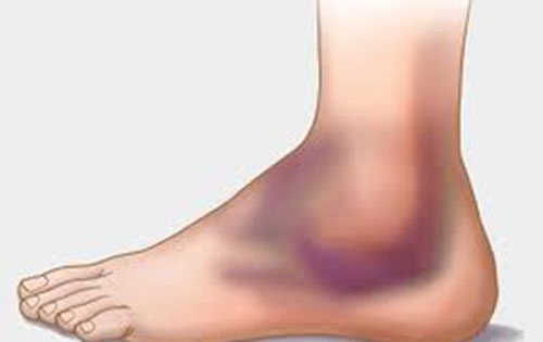 Στραμπούληγμα αστραγάλου ή διάστρεμμα ποδοκνημικής, τι είναι και πώς αντιμετωπίζεται