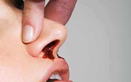 Τι πρέπει να κάνετε όταν ματώσει και τρέχει αίμα η μύτη; Πρώτες βοήθειες