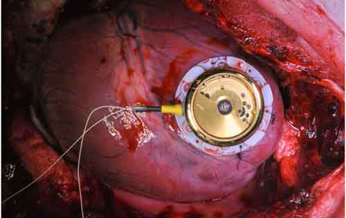 Σημαντικές ανακοινώσεις από το ετήσιο συνέδριο της Ευρωπαϊκής Καρδιολογικής Εταιρείας. Βηματοδότης χωρίς μπαταρία. Το τσάι μειώνει τον κίνδυνο θανάτου