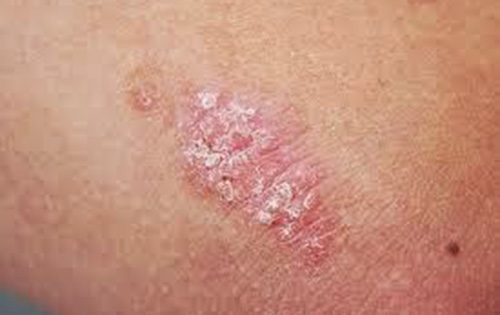 «Η ψωρίαση δεν είναι μεταδοτική, αγκάλιασέ με», Δράσεις του Καλυψώ, για την Παγκόσμια Ημέρα Ψωρίασης