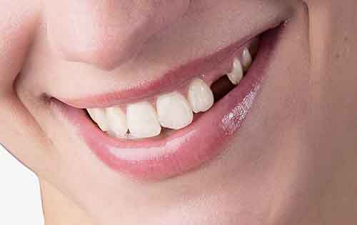 Γιατί πρέπει τα δόντια που εξάγονται να αντικαθίστανται;