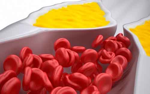 Φλεβική θρόμβωση: Παράγοντες που την προκαλούν & συμπτώματα