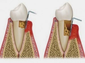 Πότε και πώς οι ρίζες των δοντιών προσβάλλονται από τερηδόνα