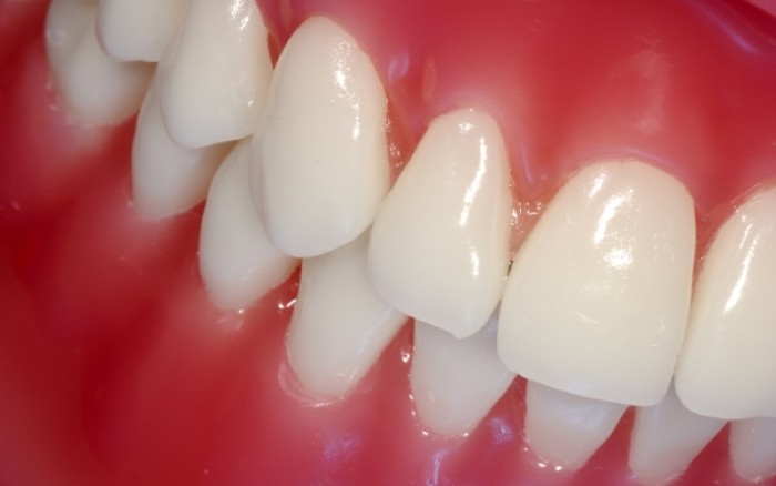 Ουλίτιδα: Γνωρίστε τα συμπτώματα για να την προλάβετε εγκαίρως