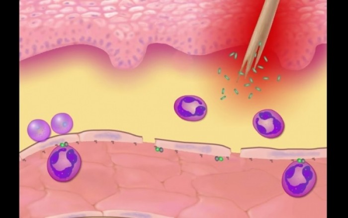 Δείτε τι προκαλεί η φλεγμονή στο σώμα