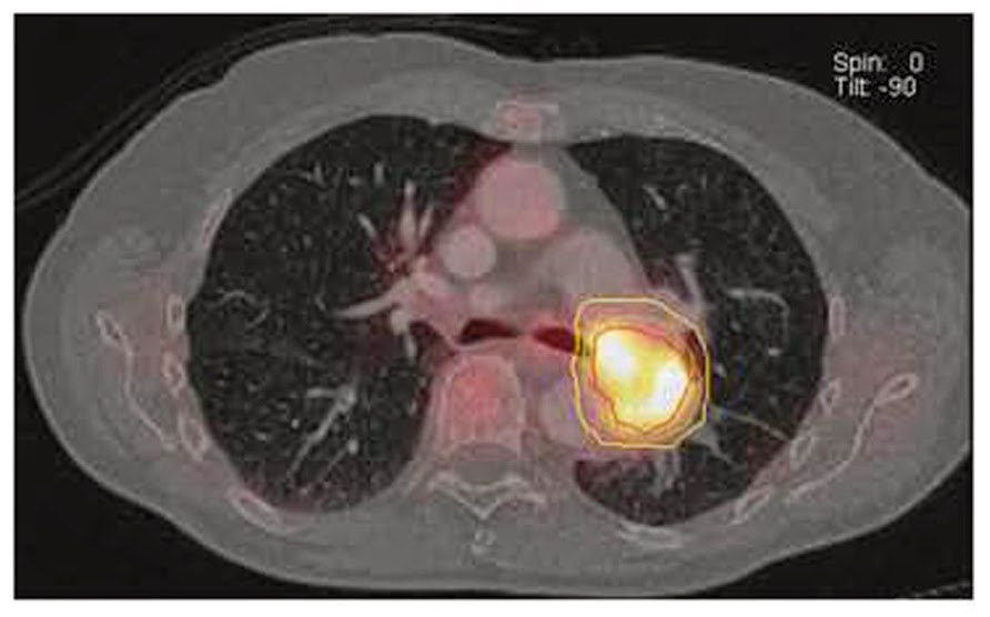 Πώς αναπτύσσεται ο καρκινικός όγκος; Τελικά τι είναι ο καρκίνος;