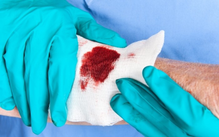Τι κάνουμε για να σταματήσει η αιμορραγία από πληγή