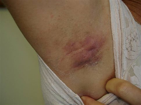 Διαπυητική ιδρωταδενίτιδα