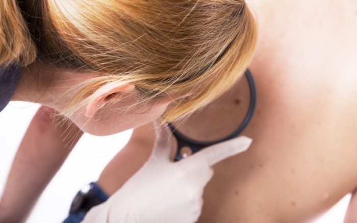 Ακτινική κεράτωση: Γιατί πρέπει να θεραπεύεται άμεσα