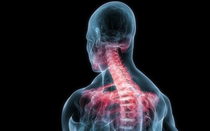 Κήλη αυχένα: Πού οφείλεται και πώς αντιμετωπίζεται