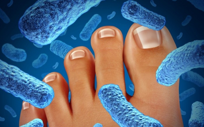 Ονυχομυκητίαση: Τι την προκαλεί και ποια τα συμπτώματα