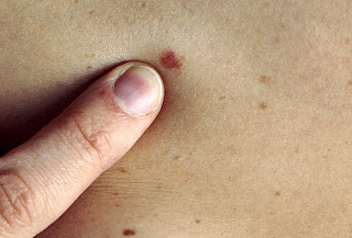 Ποιοι κινδυνεύουν περισσότερο από τον καρκίνο του δέρματος; Κάντε το τεστ