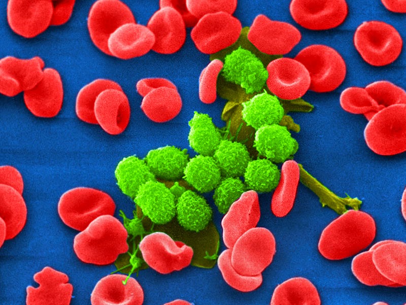 Επιβίωση δίχως εξέλιξη της νόσου, ασθενών με Χρόνια Λεμφοκυτταρική Λευχαιμία, επετεύχθη με οφατουμουμάμπη (Arzerra)