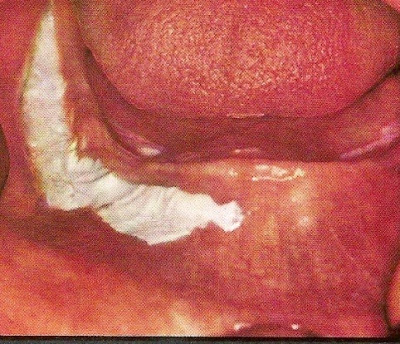 Λευκοπλακία, μια προκαρκινική βλάβη στο στόμα που πρέπει να αφαιρείται