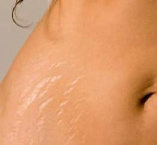 Ραγάδες και αδυνάτισμα