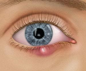 Τι είναι το χαλάζιο στο μάτι; Σε τι διαφέρει από το κριθαράκι; Από τι προκαλείται και πώς αντιμετωπίζεται; Πώς προλαμβάνεται η υποτροπή;