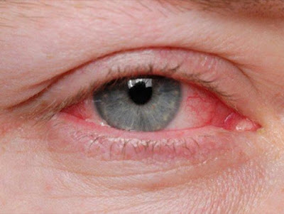Τσίμπλα, δάκρυα, κόκκινα ερεθισμένα μάτια οφείλονται σε επιπεφυκίτιδα