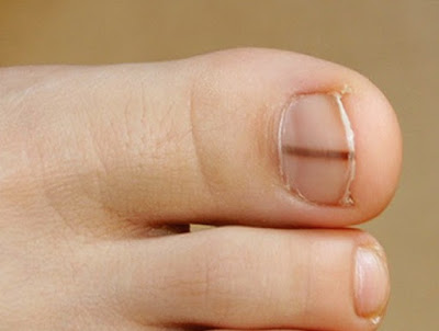 Μελάνωμα στο νύχι. Σκούρες γραμμές στα νύχια μπορεί να οφείλονται σε αιμάτωμα ή καρκίνο. Τα διαγνωστικά κριτήρια ABCDEF