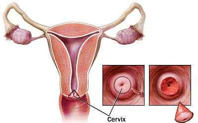 Νέα κυτταρολογική εξέταση για τον καρκίνο του τραχήλου