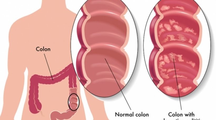 Νόσος του Crohn και ελκώδης κολίτιδα