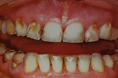Τι γνωρίζετε για τη διάβρωση των δοντιών; Πότε συμβαίνει και πώς αντιμετωπίζεται;