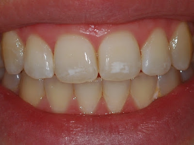 Κηλίδες στα δόντια (Υπενασβεστίωση –Υποπλασία της αδαμαντίνης)